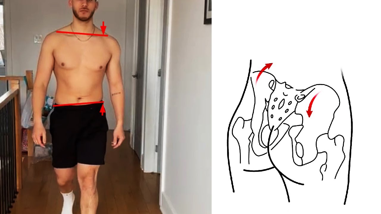 Left Tilted Fix Left Pelvic Tilt (Left AIC OR an opposite ?!) - YouTube