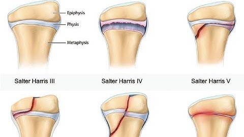 SALTER - HARRIS CLASSIFICATION OF FRACTURES