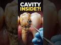 How a Cavity Forms: From Filthy Plaque to a Perfectly Restored Tooth🦷#ToothDecay#DentalCavity#Cavity