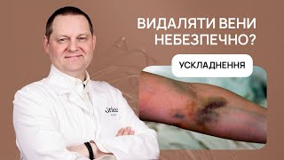 💉 ВАРИКОЗ | ВИДАЛЕННЯ ВЕН ЛАЗЕРОМ | УСКЛАДНЕННЯ