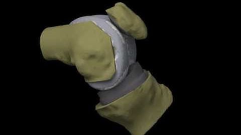 Knee motion after a total knee replacement