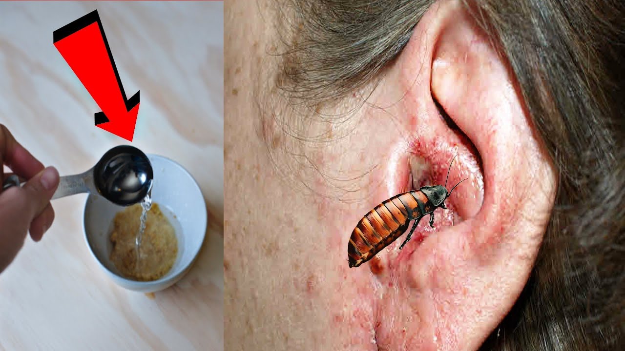 अगर कान में घुस जाये कीड़े तो मात्र 2 बूंद डाल दो यह चीज तुरंत बाहर निकल जाएगा ? - YouTube