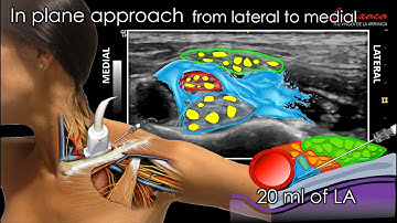 SUPRACLAVICULAR BRACHIAL PLEXUS BLOCK