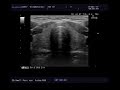 Видеозапись УЗИ - Методика последовательного сканирования щитовидной железы
