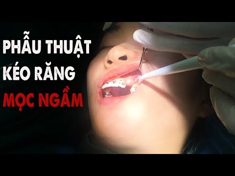 quy trình vệ sinh răng miệng tại Kemtrinam.vn