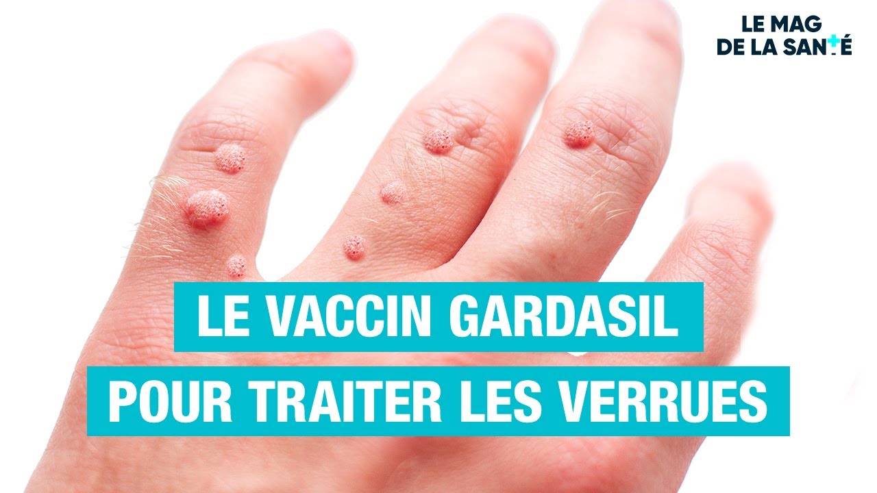  Des PAPILLOMAVIRUS responsables des verrues    Allo Docteurs