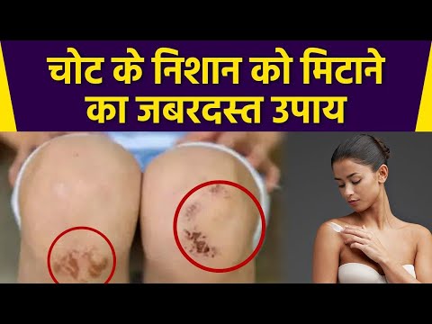 वीडियो: अपने चेहरे पर घावों की देखभाल कैसे करें (और निशान को कम करें)