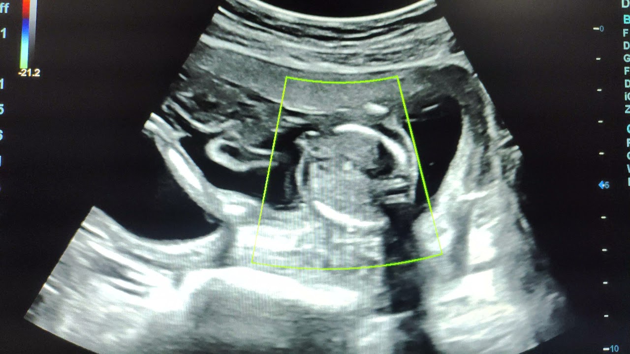 Ectopia Cordis Totalis Ultrasound Usg Scanultrasonography Fetal