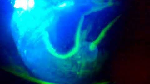 The WATER FALL in the EYE! Seidel