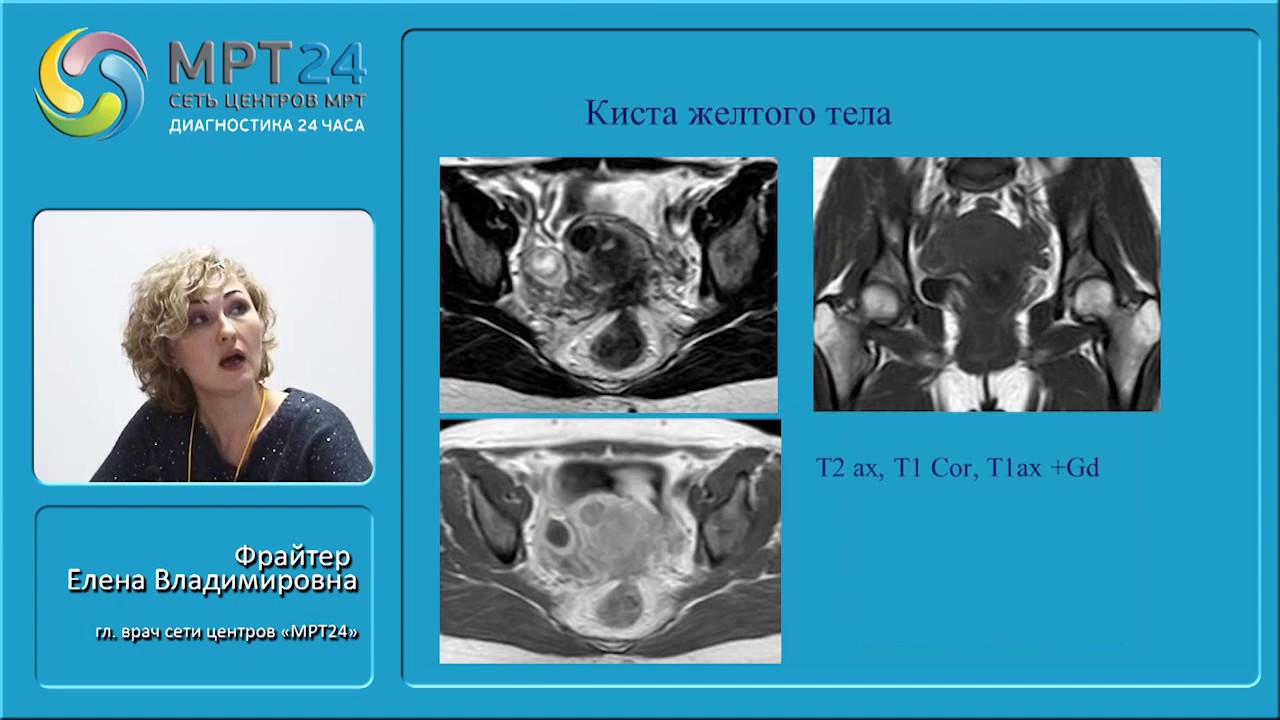 Киста яичника на мрт. Киста желтого тела яичника мрт. Желтое тело яичника мрт.