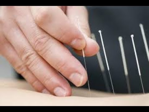как правильно ставить иголки СУ ДЖОК - YouTube