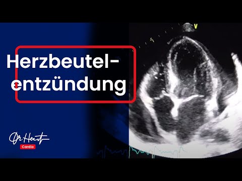 Video: Konservatives Management Von Nivolumab-induziertem Perikarderguss: Ein Fallbericht Und Eine Überprüfung Der Literatur