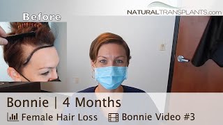 Hair Transplantation for Women Works | Hair Replacement Center for Women | Dr. Matt Huebner (Bonnie)