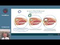 Parotid Tumors & Parotidectomy | Live Q&A (Replay) w/ Dr. Larian (6/8/26)