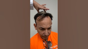 Transplante de cabello - paso a paso | Care4Hair