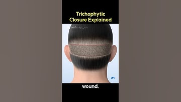Trichophytic Closure Explained