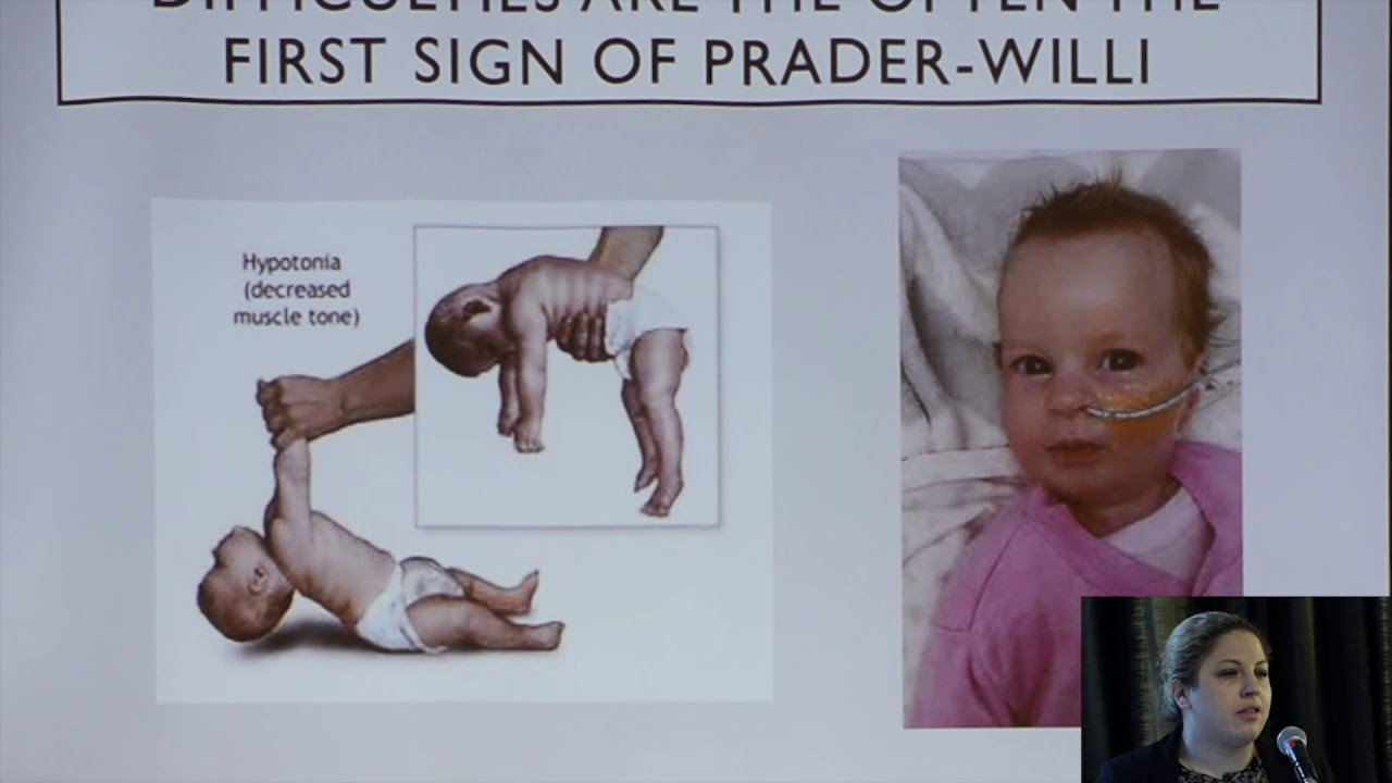 Diagnosing Prader-Willi Syndrome - YouTube