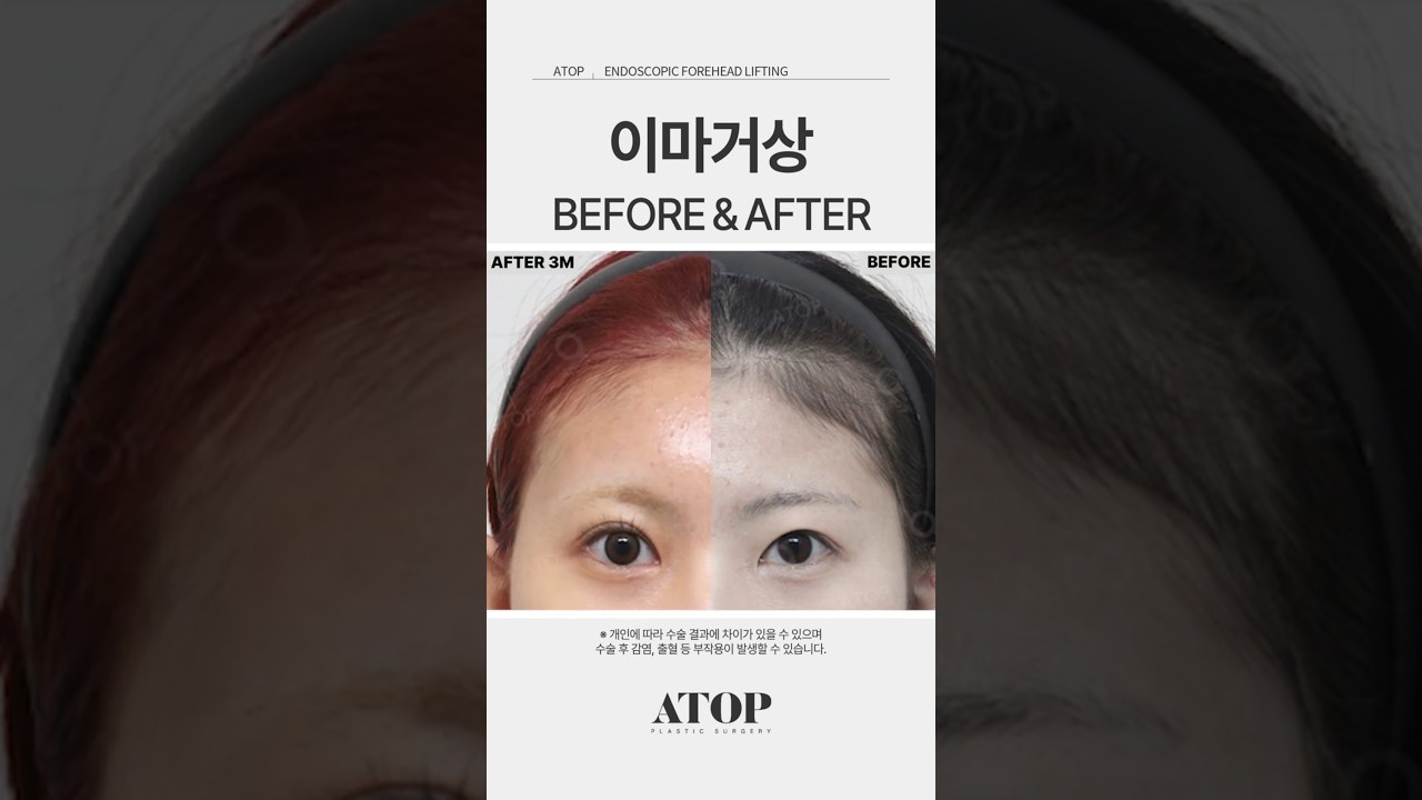 [A-TOP Phẫu thuật thẩm mỹ] Nâng trán_Đánh giá 7