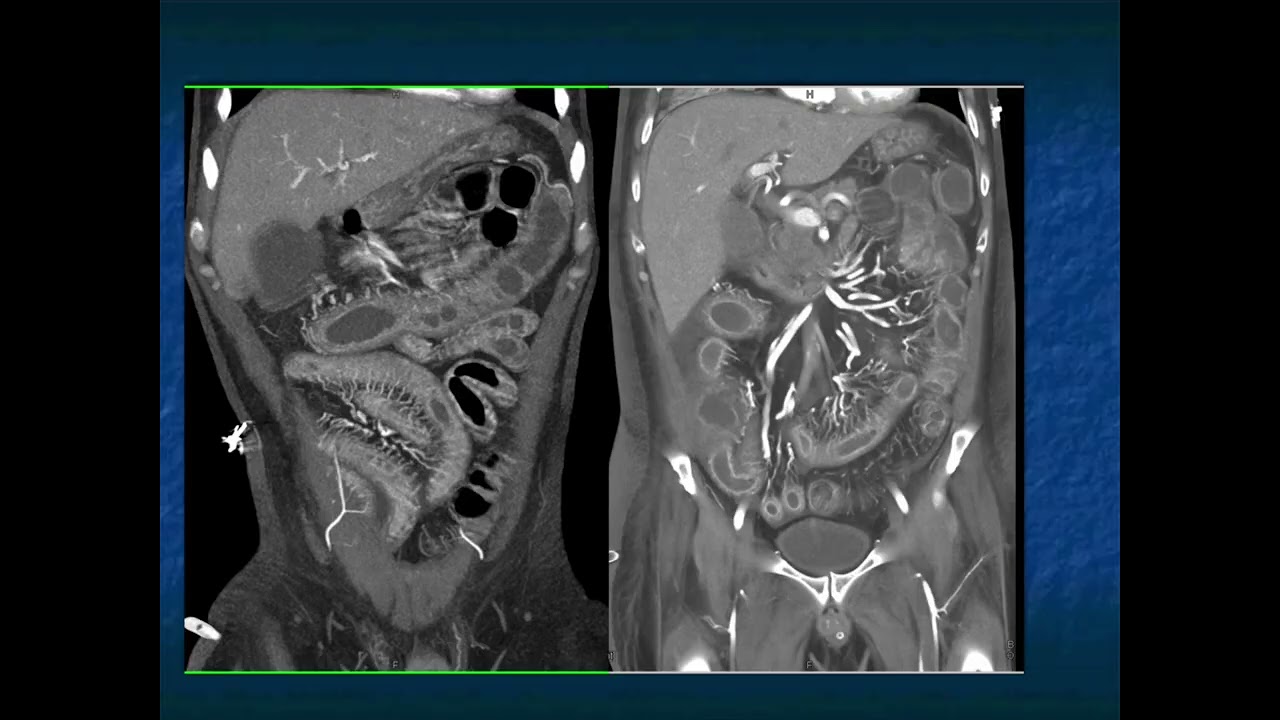 Abdominal Pain in the ER: GI Pathology - Part 2
