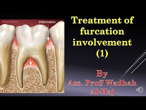 45-Periodontal surgery-14 (Furcation involvement-1)-Dr Wadhah Periodontology lectures.د/ وضاح الحاج
