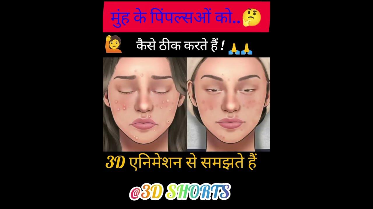 cure-pimples-in-mouth-shorts