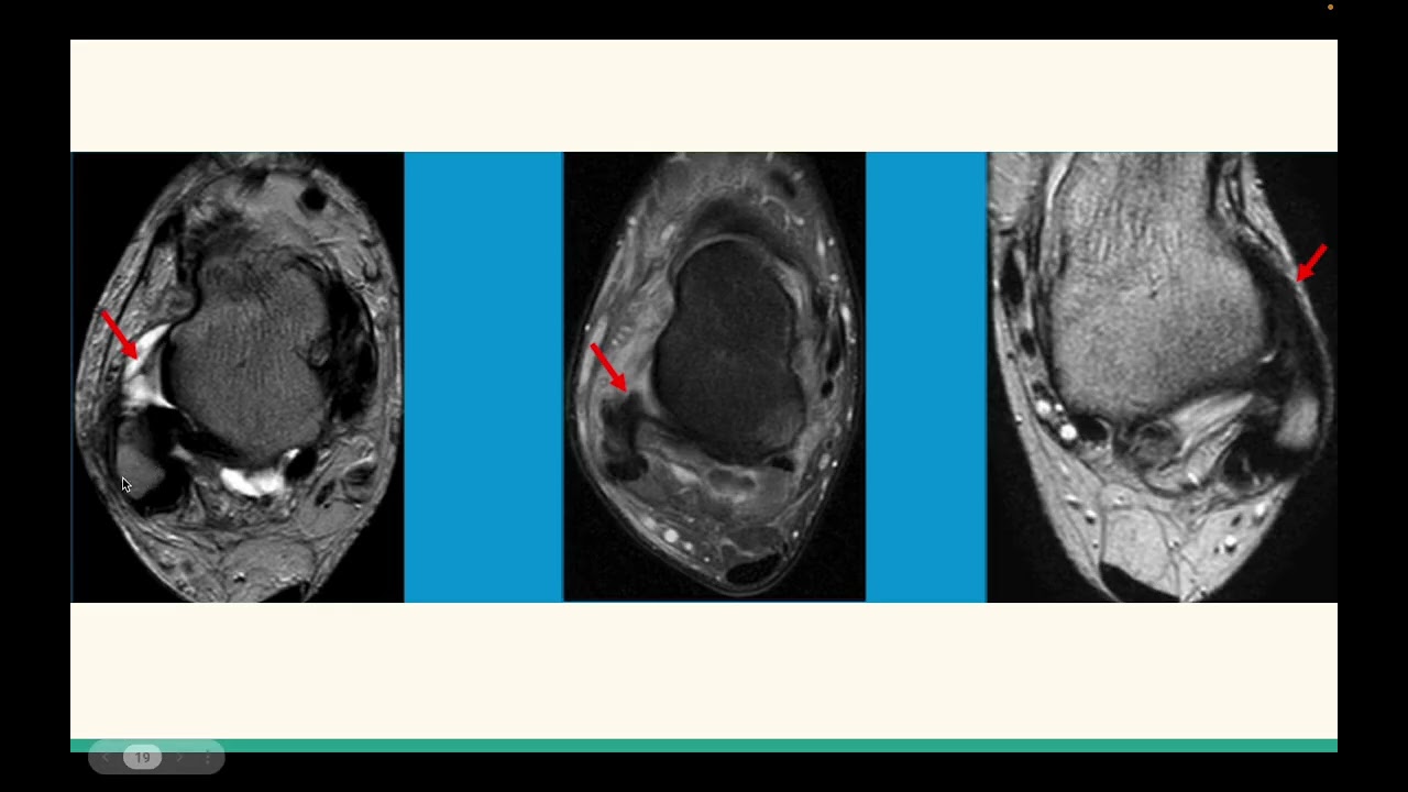 TOBILLO Normal y patologico 2025