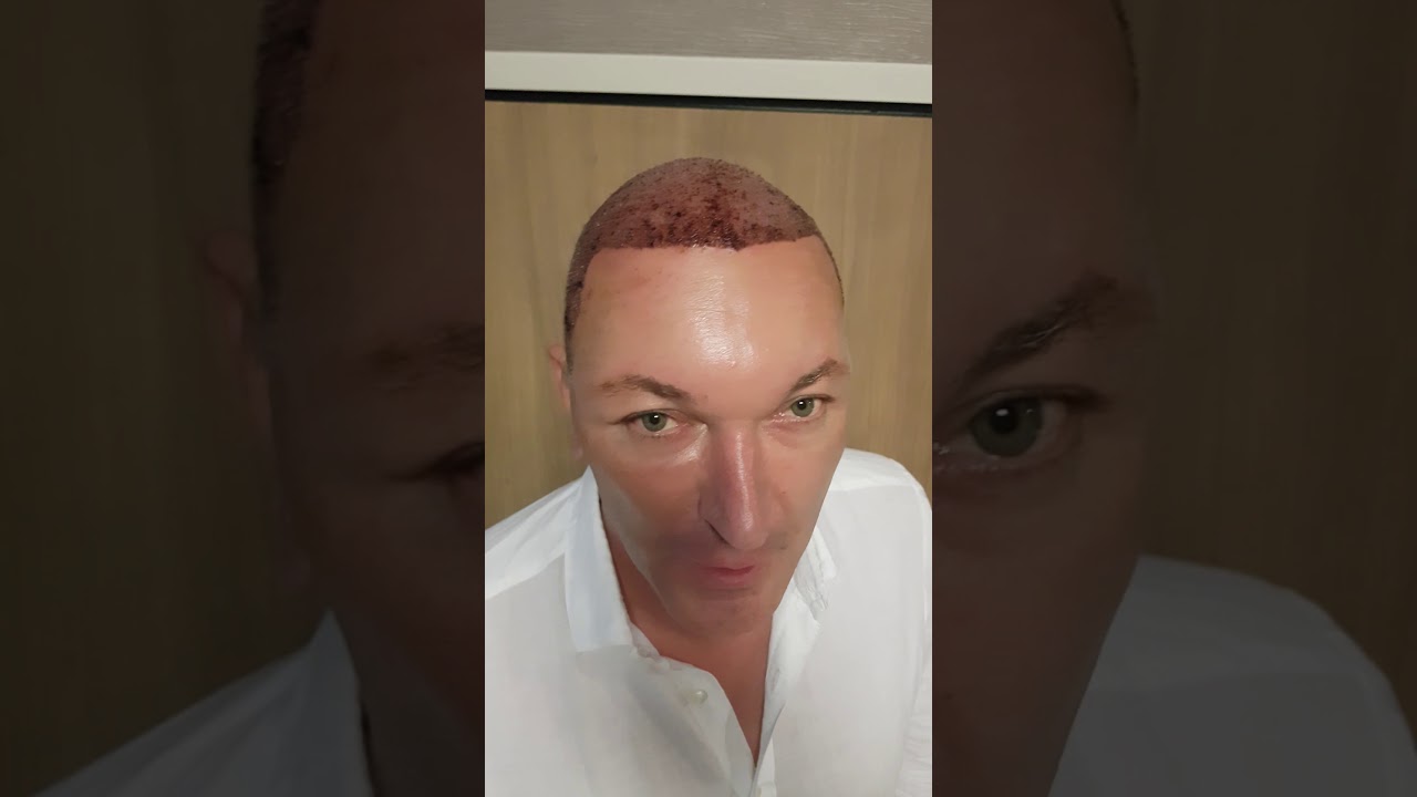 Private Hair Transplant  - Hair Upload  Dr Erkam Caymaz