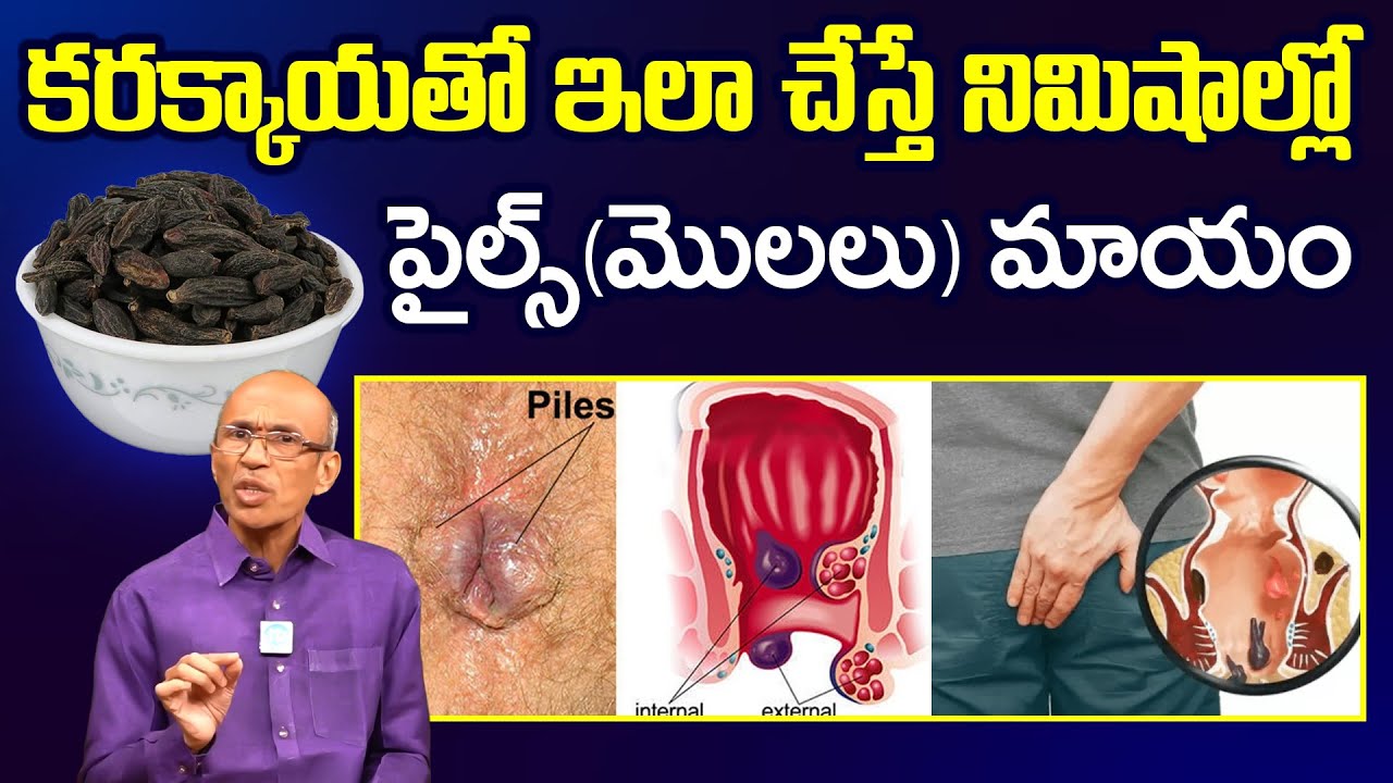 ఇలాచేస్తే ఎలాంటి పైల్స్ అయినా తగ్గాల్సిందే.! | Molalu - Piles Problem | Dr Madhusudhan Sharma