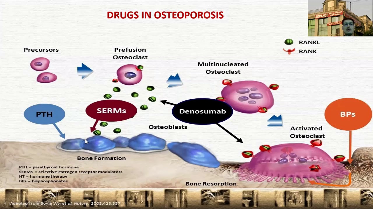 Osteoporosis : Evaluation and treatment by Dr Prathmesh Jain