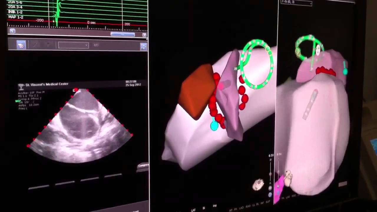 mainlander Low Radiation Ablation