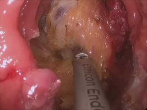 Transanal Minimally Invasive Surgical (TAMIS) Excision Of A Rectal Hemangioma