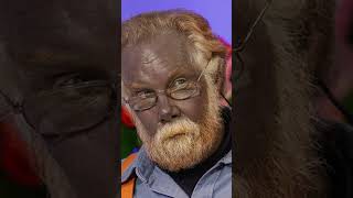 The Blue Man Paul Karason And The Unusual Effects Of Colloidal Silver Consumption