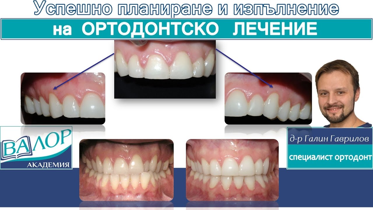 Камуфлажно лечение на трети скелетен клас с екстракция на долен резец #ортодонтия #ортодонт #брекети