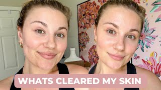ACNE UPDATE | SUPPLEMENTS I&#39;M TAKING TO CLEAR MY SKIN