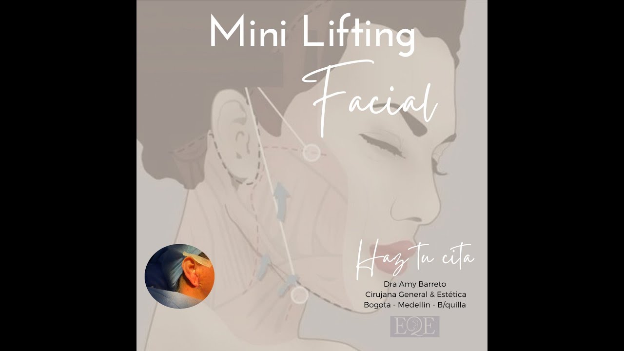 Minilifting vs. Lifting Completo: ¿Cuál es la Mejor Opción para Ti?