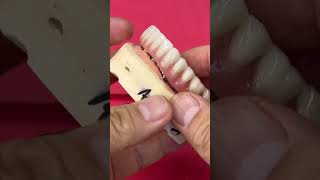 Great fit for Removable Overdenture with a Hader Bar