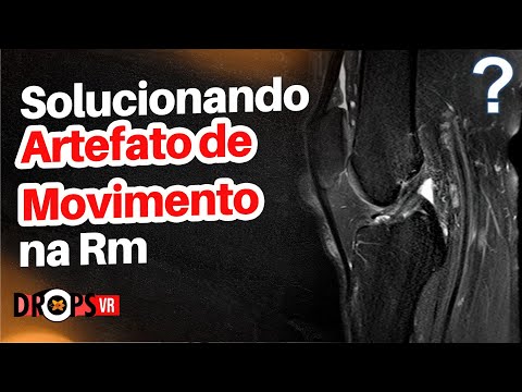 Vídeo: O que é artefato de movimento?