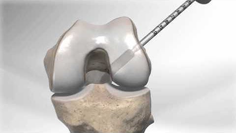 All InsideÂ® ACL Reconstruction with GraftLink
