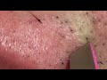 【Plucking facial hair】ずっと見ていられる盛夏のヒゲ抜き 2018.8.15（鼻下編）