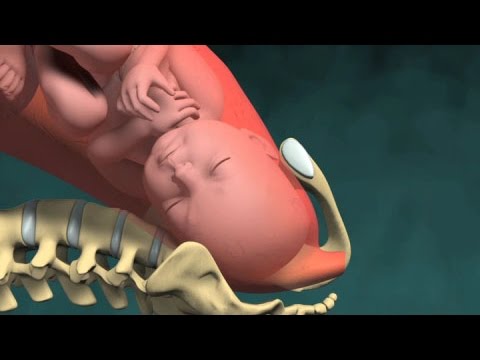 www.healthanimations.com FREE pregnancy and birth videos for your OB GYN practice. Nucleus Medical Media's www.nucleusinc.com 3D medical animation of a baby's birth shows a time lapse view of labor and delivery during normal vaginal birth in a simplified form with only the mother's skeletal structures and the baby in the uterus. Also shown in detail is dilatation (dilation or dilating) and effacement (thinning) of the cervix during childbirth contractions. Music Prelude from Bach's Cello Suite No. 1 See more 3D medical, surgery and health animations from Nucleus Medical Art at www.nucleusinc.com ÙÙØ§Ø¯Ø© Ø·Ø¨ÙØ¹ÙØ© Ð Ð¾Ð¶Ð´ÐµÐ½Ð¸Ðµ ÑÐµÐ±ÐµÐ½ÐºÐ° ÙÙØ·Ø¹ ÙÙÙØ§Ø¯Ø© Ø·ÙÙ Ø­ØªÙ Ø®Ø±ÙØ¬Ù ÙÙ Ø±Ø­Ù Ø£ÙÙ