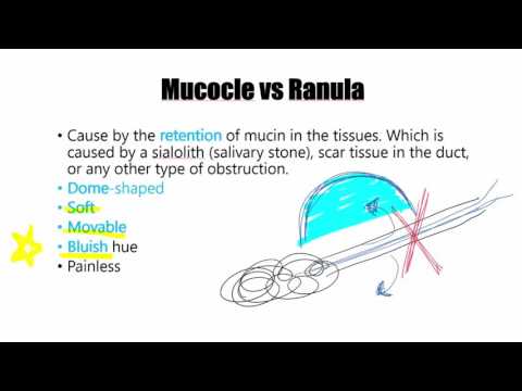 mucocele-vs-ranula.-dental-hygiene.-oral-pathology