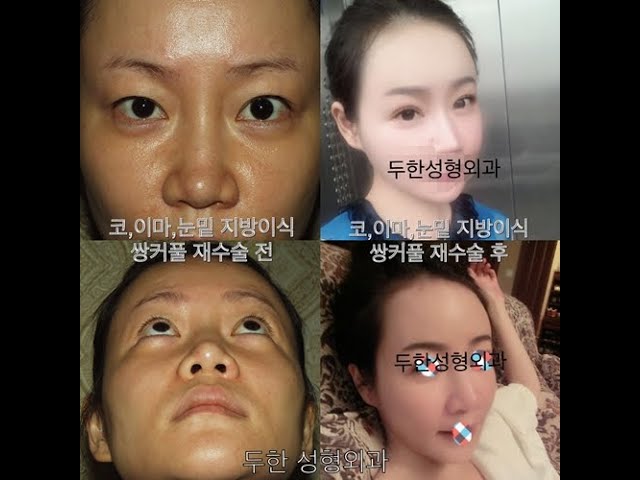 나이가 들면서 눈 아래가 볼록하게 튀어나오거나 다크서클이 짙어지는 것은 자연스러운 현상입니다.