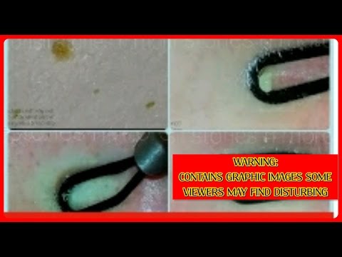 Porestrip #29, Walgreens Brand on Chin - Porestrip #29, Walgreens Brand on Chin