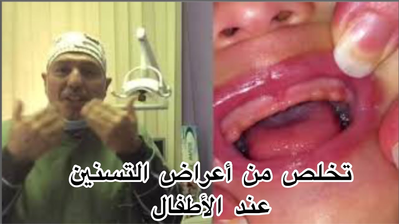 6 طرق فعالة لتخفيف آلام التسنين عند الرضيع