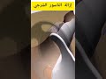 عملية إزالة الناسور الشرجي 