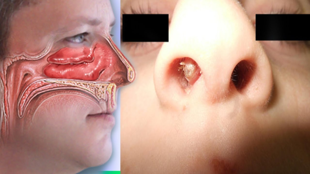 Stuffy Nose | How To Get Rid Of A Stuffy Nose Clear Blocked Nasal Congestion / How To Clear A