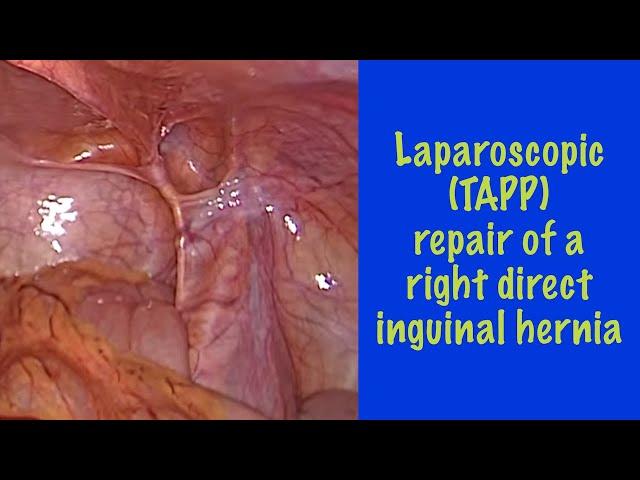Trans-abdominal pre-peritoneal (TAPP) repair of a right direct inguinal hernia
