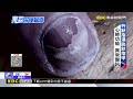 指甲變異透露健康警訊 惡性黑色素瘤可致命【東森深度報導】