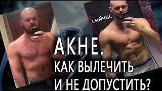 КАК ВЫЛЕЧИТЬ АКНЕ