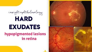 HARD EXUDATES || Hypopigmented lesions of the retina || screenshot 4